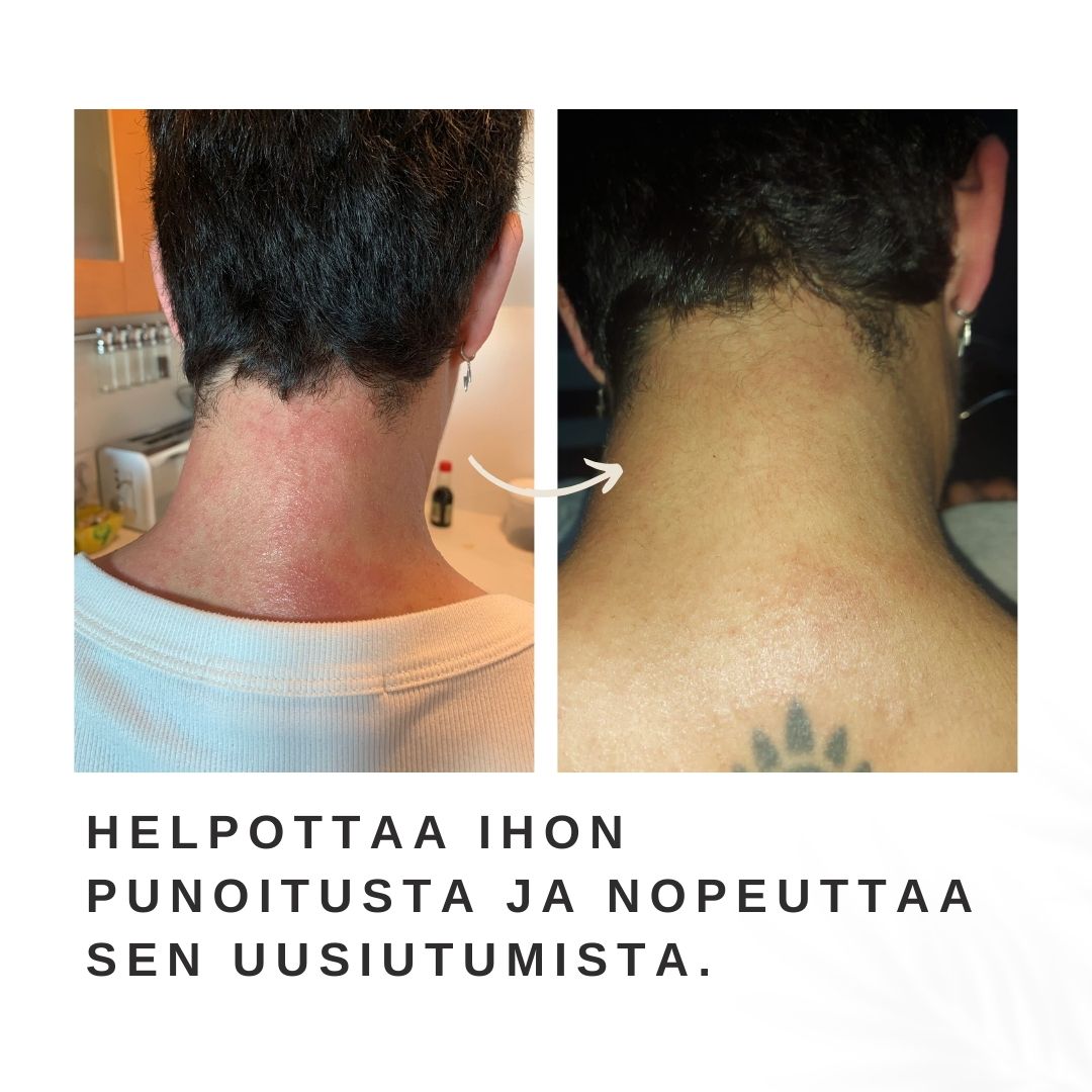 metsäbiomivoide helpottaa ja auttaa ihon punoitukseen